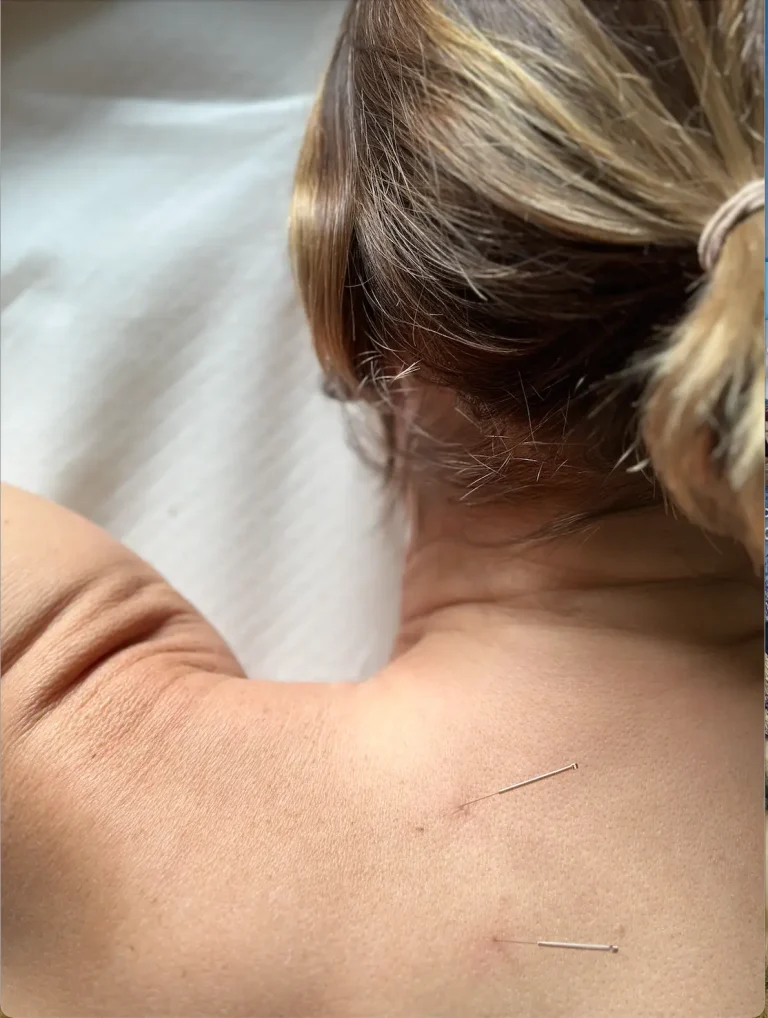 Agopuntura per il trattamento della cervicale, collo di donna con aghi inseriti nella cute in clinica di medicina cinese