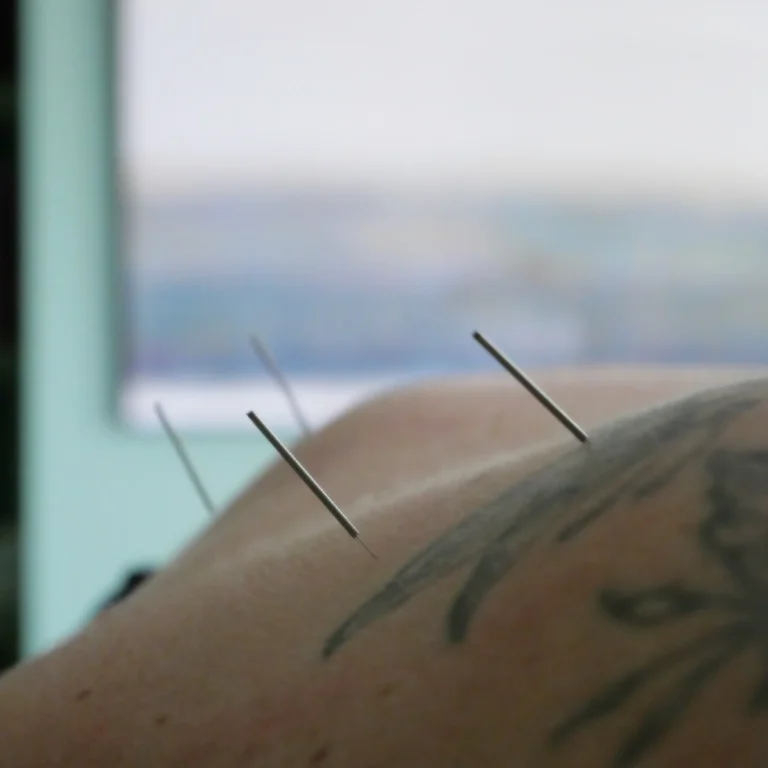 Agopuntura efficace e indolore nel trattamento della schiena, aghi sottili di metallo, luce soffusa, ambiente tranquillo di una clinica di agopuntura
