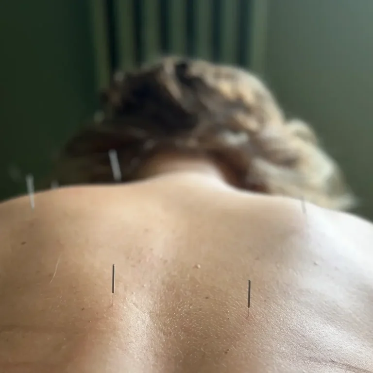 Punti di agopuntura per la cervicale sul collo doloroso di una paziente sdraiata sul lettino in clinica agopuntura